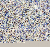 IHC staining of FFPE human glioma tissue with FGF2 antibody, HRP-secondary and DAB substrate. HIER: boil tissue sections in pH8 EDTA for 20 min and allow to cool before testing.