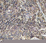 IHC staining of FFPE human liver cancer tissue with FGF2 antibody, HRP-secondary and DAB substrate. HIER: boil tissue sections in pH8 EDTA for 20 min and allow to cool before testing.