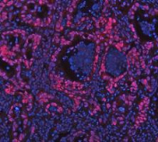 PARP1 Antibody Pancreas Cancer IF. Immunofluorescence analysis of FFPE human pancreas cancer tissue using recombinant rabbit monoclonal PARP1 antibody clone CFD-16. PARP1 staining (red) demonstrates strong nuclear localization within tumor epithelial cells, consistent with the chromatin-associated role of this DNA repair enzyme in genomic stability maintenance and nuclear stress-response signaling pathways in pancreatic carcinoma tissue. Nuclei are counterstained blue with DAPI. Heat-mediated antigen retrieval was performed in pH8 EDTA buffer prior to staining.