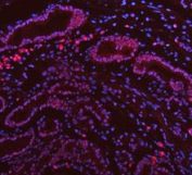 PARP1 Antibody Stomach Cancer IF. Immunofluorescence analysis of FFPE human stomach cancer tissue using recombinant rabbit monoclonal PARP1 antibody clone CFD-16. PARP1 staining (red) demonstrates predominantly nuclear localization within gastric tumor epithelial cells, consistent with the role of this chromatin-associated DNA repair enzyme in genomic surveillance, DNA strand break signaling, and nuclear stress-response pathways in proliferative carcinoma tissue. Nuclei are counterstained blue with DAPI. Heat-mediated antigen retrieval was performed in pH8 EDTA buffer prior to staining.