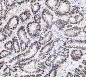 PARP1 Antibody Stomach Cancer IHC. Immunohistochemistry analysis of FFPE human stomach cancer tissue using recombinant rabbit monoclonal PARP1 antibody clone CFD-16. Tumor epithelial cell nuclei demonstrate strong HRP-DAB brown staining consistent with the chromatin-associated localization of PARP1 in DNA strand break repair, genomic surveillance, and nuclear stress-response signaling pathways within proliferative gastric carcinoma tissue. Nuclei are counterstained blue. Heat-mediated antigen retrieval was performed in pH8 EDTA buffer prior to staining.