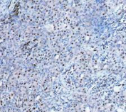 PARP1 Antibody Bladder Cancer IHC. Immunohistochemistry analysis of FFPE human bladder cancer tissue using recombinant rabbit monoclonal PARP1 antibody clone CFD-16. Tumor cell nuclei demonstrate HRP-DAB brown staining consistent with the chromatin-associated localization of PARP1 in DNA damage repair, genomic stability regulation, and nuclear stress-response signaling pathways commonly active in proliferative tumor tissue. Nuclei are counterstained blue. Heat-mediated antigen retrieval was performed in pH8 EDTA buffer prior to staining.