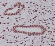 IHC staining of FFPE human endometrial carcinoma tissue with K48-Linkage Specific Ubiquitin antibody. HIER: boil tissue sections in pH6, 10mM citrate buffer, for 10-20 min and allow to cool before testing.