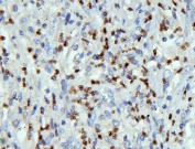 IHC staining of FFPE human lung cancer with LBR antibody. HIER: boil tissue sections in pH6, 10mM citrate buffer, for 20 min and allow to cool before testing.