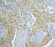 IHC staining of FFPE human lung cancer with LONP1 antibody. HIER: boil tissue sections in pH6, 10mM citrate buffer, for 20 min and allow to cool before testing.