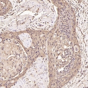 IHC staining of FFPE human esophageal carcinoma tissue with Ubiquitin antibody. HIER: boil tissue sections in pH6, 10mM citrate buffer, for 10-20 min and allow to cool before testing.