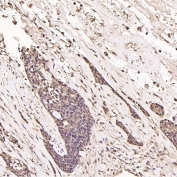 IHC staining of FFPE human breast cancer tissue with Ubiquitin antibody. HIER: boil tissue sections in pH6, 10mM citrate buffer, for 10-20 min and allow to cool before testing.