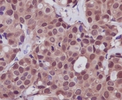 IHC staining of FFPE human breast tissue with HSP70 antibody. HIER: boil tissue sections in pH6, 10mM citrate buffer, for 10-20 min and allow to cool before testing.