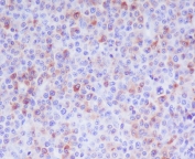 IHC staining of FFPE human T-cell lymphoma tissue with Granzyme B antibody. HIER: boil tissue sections in pH6, 10mM citrate buffer, for 10-20 min and allow to cool before testing.