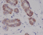 IHC staining of FFPE human breast cancer with c-Kit antibody. HIER: boil tissue sections in pH6, 10mM citrate buffer, for 10-20 min and allow to cool before testing.