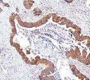 IHC staining of FFPE human colon carcinoma with mTOR antibody. HIER: boil tissue sections in pH6 citrate buffer for 20 min and allow to cool before testing.
