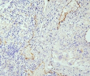 IHC staining of FFPE human lung cancer with eNOS antibody. HIER: boil tissue sections in pH6, 10mM citrate buffer, for 20 min and allow to cool before testing.