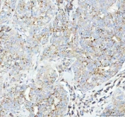 IHC staining of FFPE human breast cancer tissue with FLOT1 antibody. HIER: boil tissue sections in pH8 EDTA for 10-20 min and allow to cool before testing.