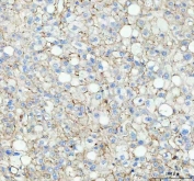 IHC staining of FFPE human liver cancer tissue with FLOT1 antibody. HIER: boil tissue sections in pH8 EDTA for 10-20 min and allow to cool before testing.