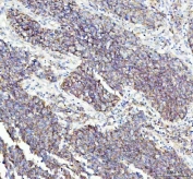 IHC staining of FFPE human lung squamous cell carcinoma tissue with FLOT1 antibody. HIER: boil tissue sections in pH8 EDTA for 10-20 min and allow to cool before testing.