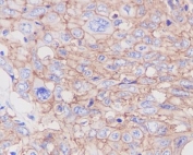 IHC staining of FFPE human cervical cancer with GLUT1 antibody. HIER: boil tissue sections in pH6, 10mM citrate buffer, for 10-20 min followed by cooling at RT for 20 min.