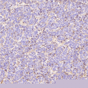 GLUT1 Antibody immunohistochemistry analysis in human thymoma tissue. FFPE human thymoma section shows HRP-DAB brown membranous and cytoplasmic staining in tumor epithelial cells, consistent with GLUT1 (SLC2A1) localization in metabolically active tumor cell populations. Surrounding stromal components display minimal background staining. The section was stained using GLUT1 antibody at 1:200 dilution.