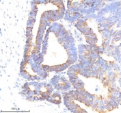 IHC staining of FFPE human colon cancer tissue with GLUT3 antibody. HIER: boil tissue sections in pH8 EDTA for 20 min and allow to cool before testing.