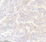 IHC staining of FFPE human stomach cancer tissue with GLUT3 antibody. HIER: boil tissue sections in pH8 EDTA for 20 min and allow to cool before testing.
