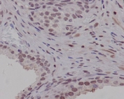 IHC staining of FFPE human prostate carcinoma with PIM1 antibody. HIER: boil tissue sections in pH6, 10mM citrate buffer, for 10-20 min followed by cooling at RT for 20 min.