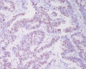 IHC staining of FFPE human colon cancer with TOP2A antibody. HIER: boil tissue sections in pH6, 10mM citrate buffer, for 10-20 min and allow to cool before testing.