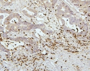 IHC staining of FFPE human colon cancer tissue with PEF1 antibody. HIER: boil tissue sections in pH8 EDTA for 20 min and allow to cool before testing.