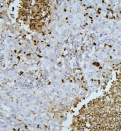 IHC staining of FFPE human lung cancer tissue with PEF1 antibody. HIER: boil tissue sections in pH8 EDTA for 20 min and allow to cool before testing.