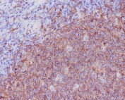 IHC staining of FFPE human tonsil tissue with CD20 antibody. HIER: boil tissue sections in pH6, 10mM citrate buffer, for 10-20 min and allow to cool before testing.