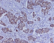 IHC staining of FFPE human breast cancer with BMP4 antibody. HIER: boil tissue sections in pH6, 10mM citrate buffer, for 10-20 min and allow to cool before testing.