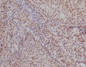 IHC staining of FFPE human tonsil tissue with Ku70 antibody. HIER: boil tissue sections in pH6, 10mM citrate buffer, for 10-20 min and allow to cool before testing.