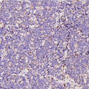 IHC staining of FFPE human small cell lung cancer tissue with LAMP-2A antibody. HIER: boil tissue sections in pH6, 10mM citrate buffer, for 10-20 min and allow to cool before testing.