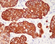 IHC staining of FFPE human urothelial carcinoma with KRT5 antibody. HIER: boil tissue sections in pH6, 10mM citrate buffer, for 10-20 min and allow to cool before testing.