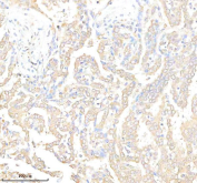 Tissue Factor Antibody Lung Cancer IHC. Immunohistochemistry analysis of FFPE human lung cancer tissue using Tissue Factor antibody. Tumor epithelial cells demonstrate membranous and cytoplasmic HRP-DAB brown staining consistent with the surface-associated localization of Tissue Factor / F3 / CD142 in coagulation pathway activation, inflammatory signaling, and tumor-associated prothrombotic activity within pulmonary carcinoma tissue. Nuclei are counterstained blue. Heat-induced epitope retrieval was performed using EDTA buffer, pH8.0, prior to staining.
