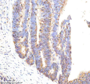 Tissue Factor Antibody Colon Cancer IHC. Immunohistochemistry analysis of FFPE human colon cancer tissue using Tissue Factor antibody. Tumor epithelial cells demonstrate membranous and cytoplasmic HRP-DAB brown staining consistent with the surface-associated localization of Tissue Factor / CD142 in coagulation signaling, inflammatory pathway activation, and tumor-associated procoagulant activity within colorectal carcinoma tissue. Nuclei are counterstained blue. Heat-induced epitope retrieval was performed using EDTA buffer, pH8.0, prior to staining.
