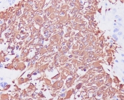 IHC staining of FFPE human glioma with GFAP antibody. HIER: boil tissue sections in pH6, 10mM citrate buffer, for 10-20 min and allow to cool before testing.