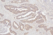 IHC staining of FFPE human colon cancer with Semaphorin 3B antibody. HIER: boil tissue sections in pH8 EDTA for 20 min and allow to cool before testing.