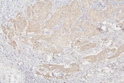 IHC staining of FFPE human breast cancer with Semaphorin 3B antibody. HIER: boil tissue sections in pH8 EDTA for 20 min and allow to cool before testing.