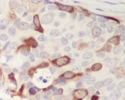 IHC staining of FFPE human breast cancer with Cyclin B1 antibody. HIER: boil tissue sections in pH6, 10mM citrate buffer, for 10-20 min and allow to cool before testing.