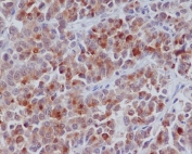 IHC staining of FFPE human colon cancer with CCNB1 antibody. HIER: boil tissue sections in pH6, 10mM citrate buffer, for 10-20 min and allow to cool before testing.