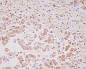 IHC staining of FFPE human colon cancer with MMP9 antibody. HIER: boil tissue sections in pH6, 10mM citrate buffer, for 10-20 min and allow to cool before testing.