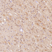Immunohistochemistry of Glutamine Synthetase Antibody CCH-7 in human glioblastoma. Formalin-fixed, paraffin-embedded human glioblastoma tissue demonstrates diffuse cytoplasmic HRP-DAB brown staining in tumor cells, consistent with Glutamate-ammonia ligase (GLUL) expression in astrocytic lineage-derived cells. Background stromal elements show comparatively lower signal. The antibody was used at a 1:250 dilution for paraffin-embedded tissue analysis.
