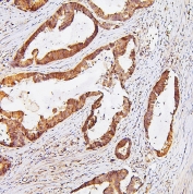 IHC staining of FFPE human colon cancer with TDRD3 antibody at 1ug/ml. HIER: boil tissue sections in pH6, 10mM citrate buffer, for 10-20 min and allow to cool before testing.