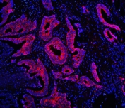 Immunofluorescent staining of FFPE human intestinal cancer with TDRD3 antibody (red) at 1ug/ml and DAPI nuclear stain (blue). HIER: steam section in pH6 citrate buffer for 20 min.