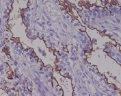 IHC staining of FFPE human ovarian cancer with Mucin-1 antibody. HIER: boil tissue sections in pH6, 10mM citrate buffer, for 10-20 min and allow to cool before testing.