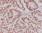 IHC staining of FFPE human gastric carcinoma with phospho-CREB1 antibody (pS133) antibody. HIER: boil tissue sections in pH6, 10mM citrate buffer, for 10-20 min and allow to cool before testing.