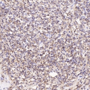 IHC staining of FFPE human Hodgkin's lymphoma tissue with CD19 antibody. HIER: boil tissue sections in pH6 citrate buffer for 20 min and allow to cool before testing.