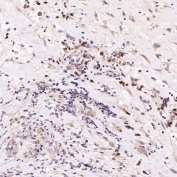 IHC staining of FFPE human esophageal carcinoma tissue with CD19 antibody. HIER: boil tissue sections in pH6 citrate buffer for 20 min and allow to cool before testing.