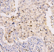 IHC staining of FFPE human lung cancer with BRG1 antibody. HIER: boil tissue sections in pH6, 10mM citrate buffer, for 20 min and allow to cool before testing.