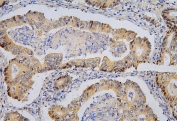 IHC staining of FFPE human rectal cancer with BRG1 antibody. HIER: boil tissue sections in pH6, 10mM citrate buffer, for 20 min and allow to cool before testing.