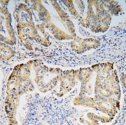 IHC staining of FFPE human rectal cancer with BRG1 antibody. HIER: boil tissue sections in pH6, 10mM citrate buffer, for 20 min and allow to cool before testing.
